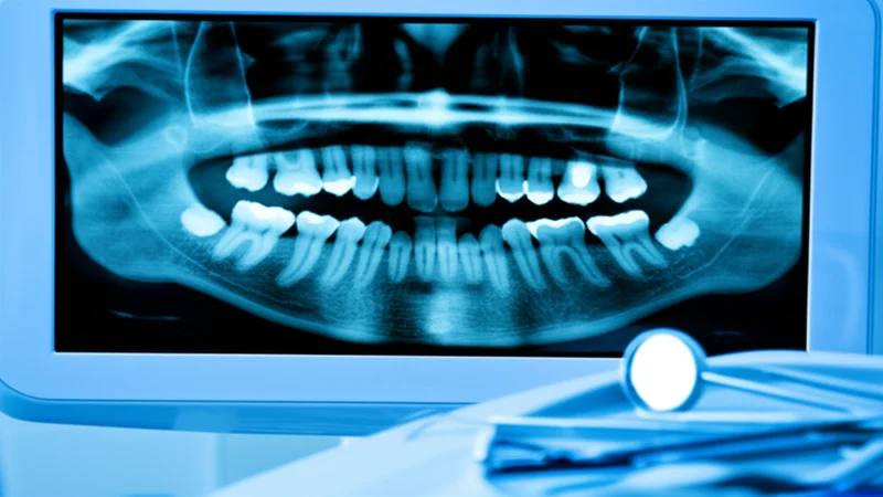 Root Canal Cost in Hialeah (2026)